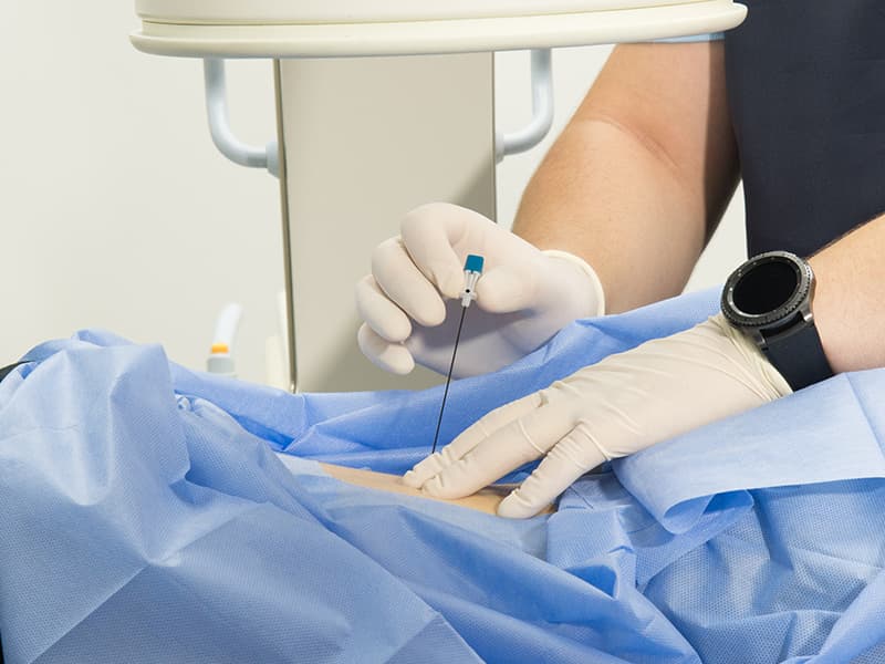 epidural-anestezi-nedir